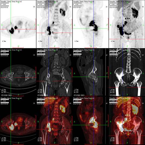 霍奇金**细胞淋巴瘤治疗前全身petct
