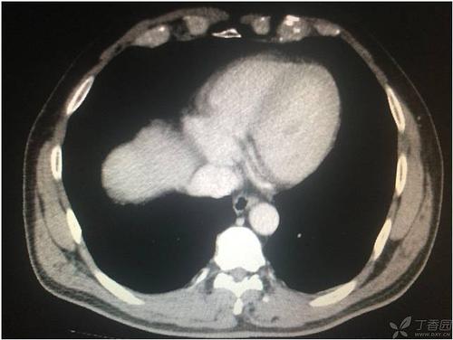 病例挑战:转移性右下腹痛,不是阑尾炎会是什么呢?