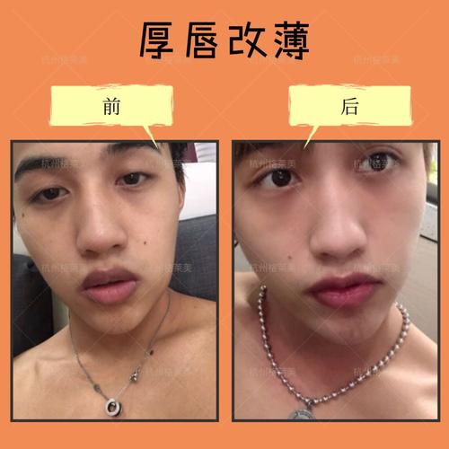 厚唇改薄