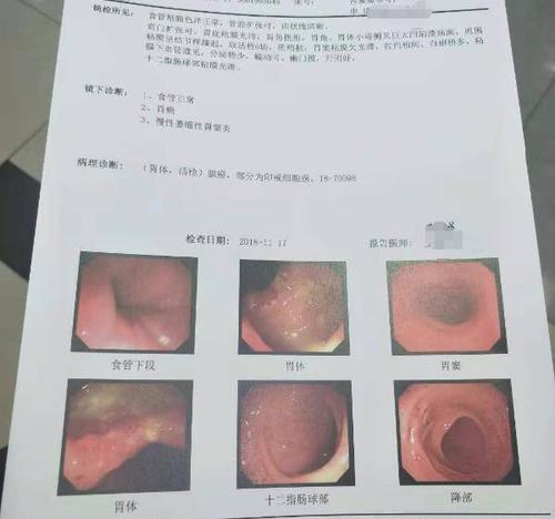 请看图片这是哪个阶段,胃癌