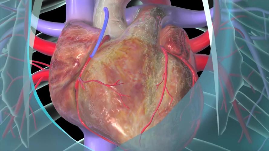 3d冠状动脉旁路移植术医疗视频_3840x2160_高清视频
