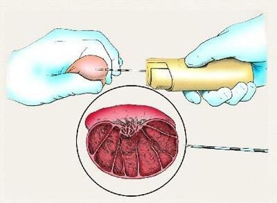 通过睾丸穿刺获取精子做试管婴儿