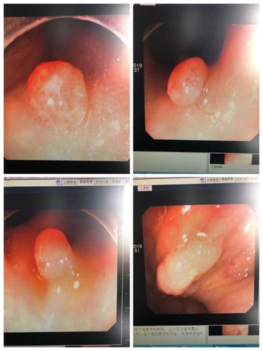 相信吗 写美篇 内镜下息肉切除后就是这样的 早发现,内镜下一个微创