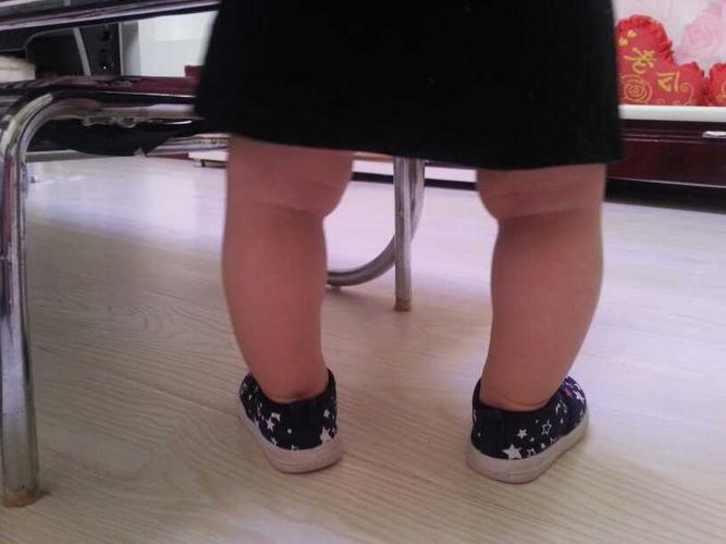 宝妈们看看我家宝宝的腿弯成这样怎么办啊!11个半月