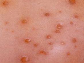 >> 验证的症状   四,滴虫性阴道炎:   滴虫性阴道炎是一种传染性疾病