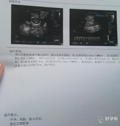 求助专业医生,单绒双羊双胎,之前的彩超羊水一直