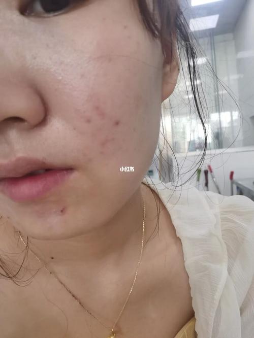 求助长春的集美们,长春光子嫩肤哪里做的效果好啊,想去红痘印,有点