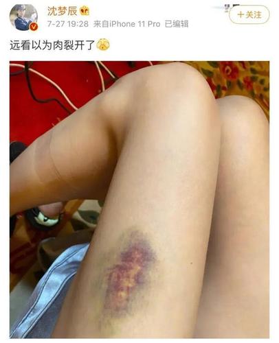 沈梦辰深夜发大腿受伤淤青照,看到杨迪回复,网友:海涛要吃醋了
