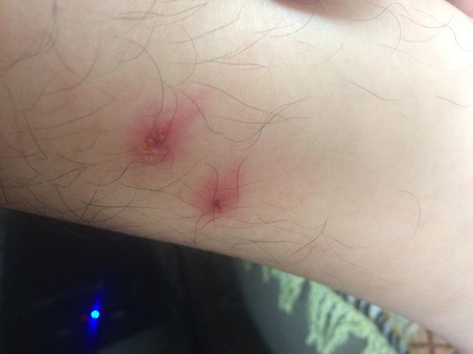 这是让什么咬的,螨虫吗?