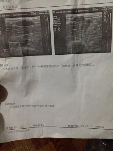 左大腿皮下淋巴结肿需要动刀手术吗?