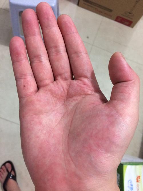 手掌一直这样红白相间,是怎么回事.