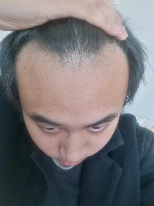 发际线高怎么办?教你一个简单快速的办法!