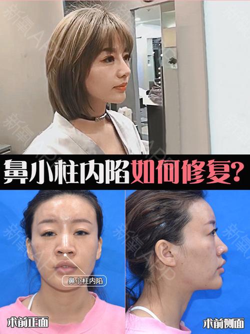 隆鼻案例# 鼻小柱内陷该如何进行修复?