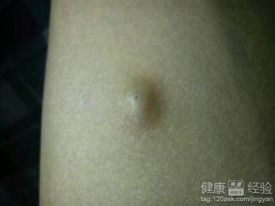 皮脂腺囊肿和脂肪瘤区别在哪