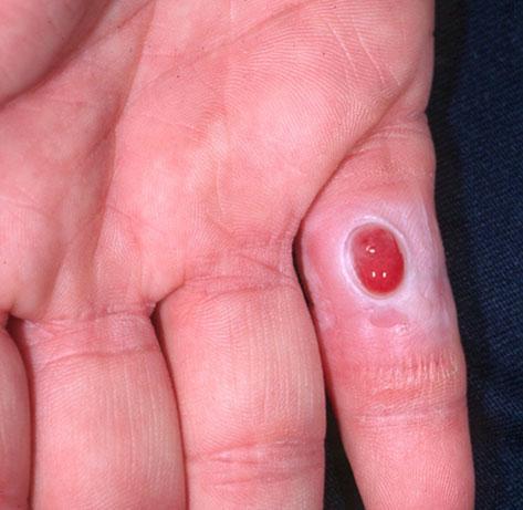 手指肿瘤鉴别诊断:从入门到掌握