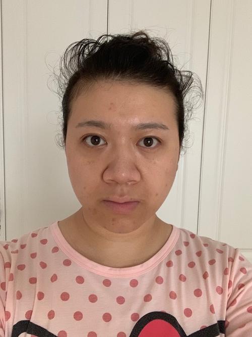 脸大,轻微脊柱侧弯导致脸型不对称,蒜头鼻,鼻翼宽,人中长,有黑眼圈