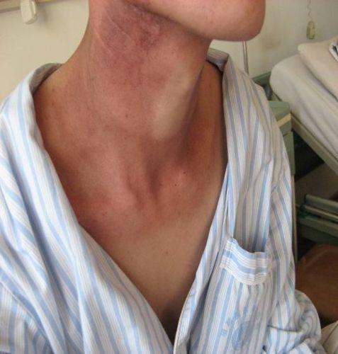 鼻咽癌放疗放射性皮炎