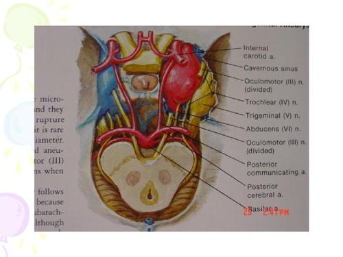 蛛网膜下腔出血的黑板报 黑板报图片大全