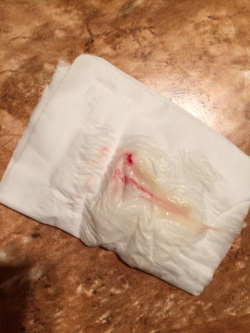 [试管婴儿]请问这是着床出血吗?有图慎入!