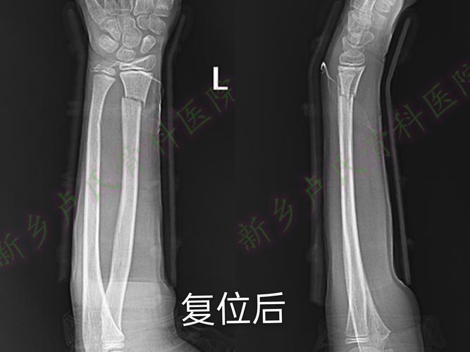 儿童尺桡骨远端骨折