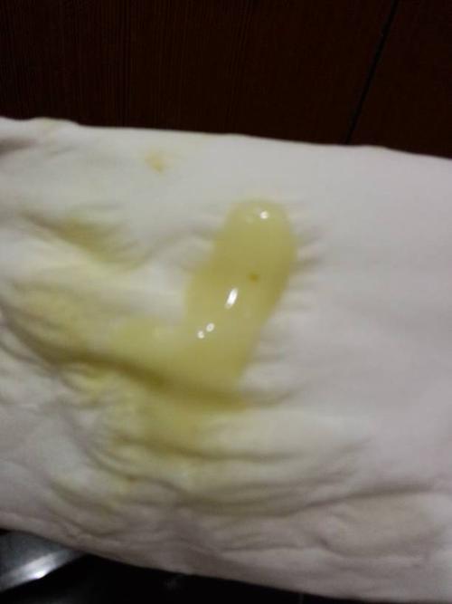 问:白带这样的,怎么回事啊,上个月检查出轻度宫颈糜烂,医生开了十二天