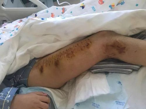 除了脑部,小宇轩的腿也由于车祸撞击造成粉碎性骨折.