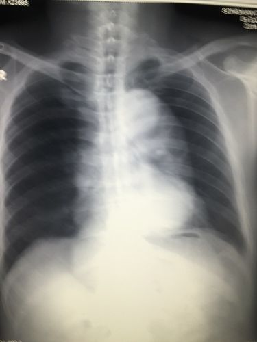 胸片示降主动脉及主动脉弓明显扩张增宽.