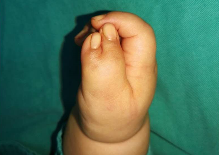 下图是我们之前做过的一例多指切除手术,这个孩子双手都是拇指多指