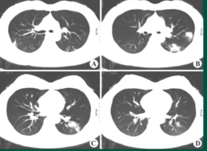 支气管肺炎(在支气管处有阴影,那块状影不是癌)