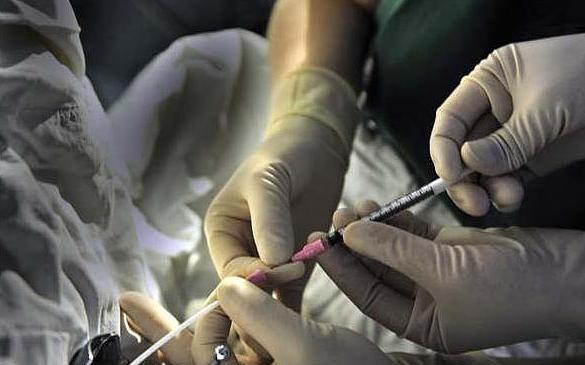 实拍试管婴儿取卵抽精全过程