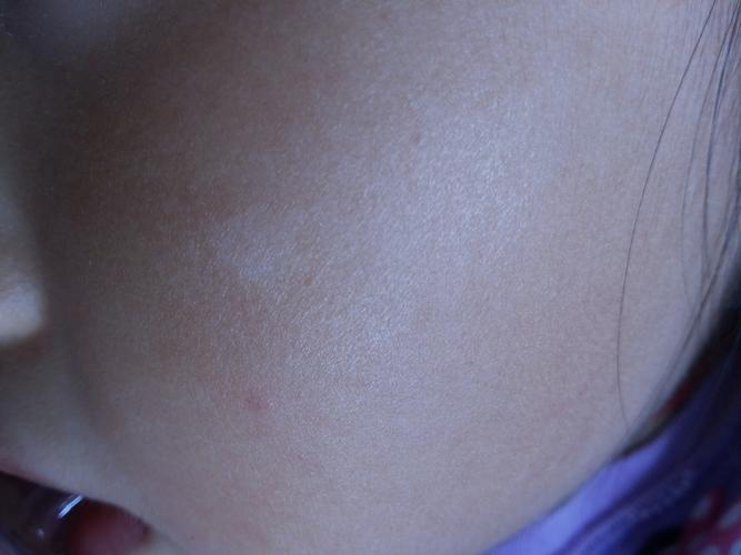 沙发回复sunndy2013-09-29 20:51:47这个看起来更像白色糠疹