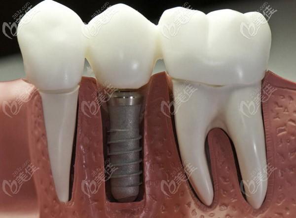 治疗性质的牙科治疗,比如拔牙,根管治疗,治疗牙周病,牙龈炎等的费用