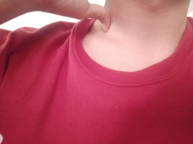 帮忙看看这是锁骨窝淋巴结吗?