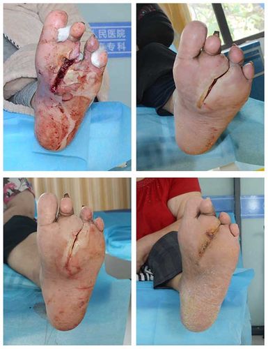 糖尿病老人脚烂得厉害要怎么治疗才能好?