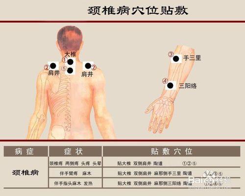 祛痛堂老裴家膏药如何按穴位贴敷?