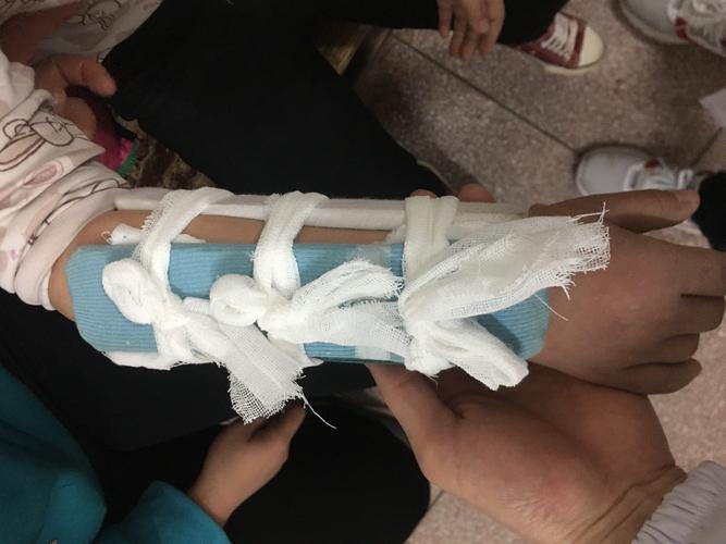 根据患者年龄及骨折类型,医生决定给予手法复位小夹板外固定治疗!