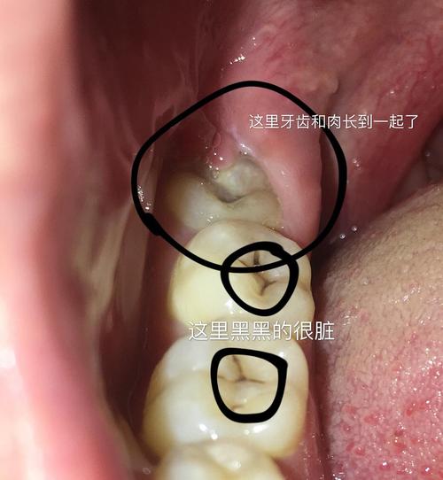 牙好像长到肉里了牙不好看慎入