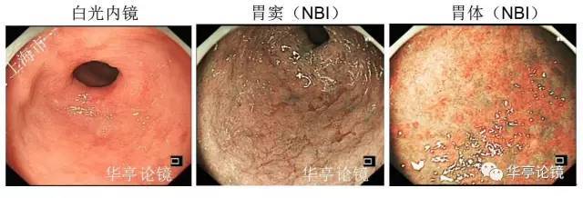 一个胃角的"癌变之路"