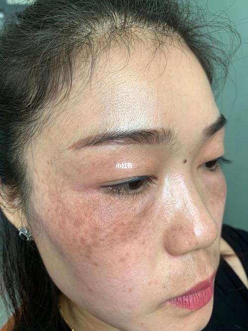 真皮斑的治疗过程_美白祛斑_美妆_护肤