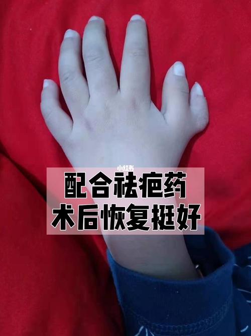 多指术后 瘢痕几乎看不出来_多指_医疗健康_医疗健康