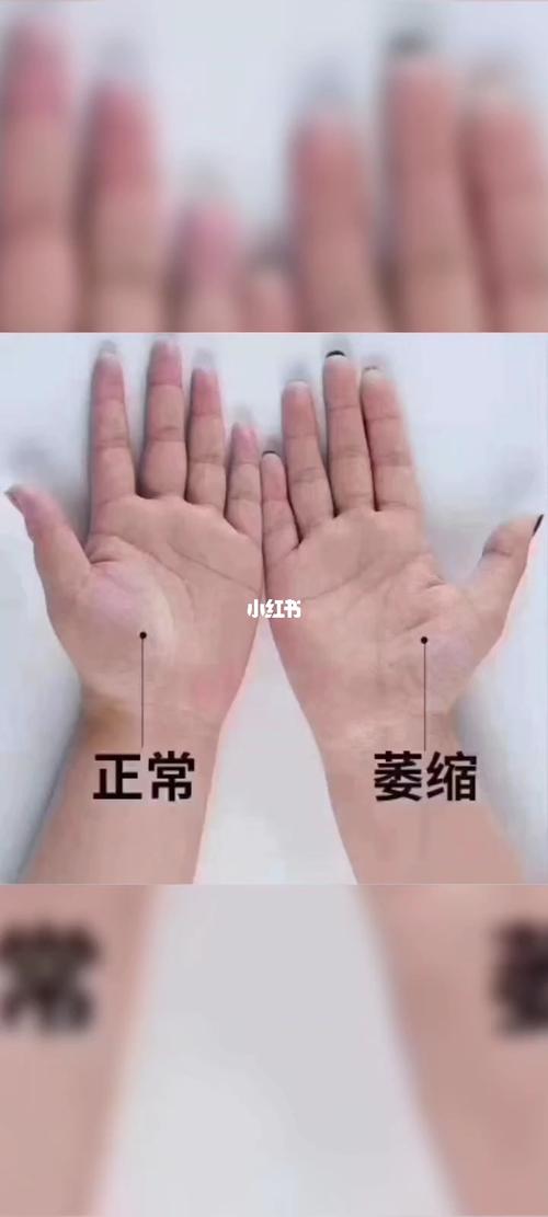 7815 教你一招 伸出你的手掌 摸摸大鱼际那块肉是否 凹陷 不饱满