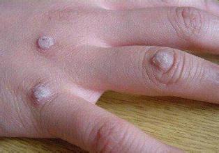 手上长了瘊子怎么治疗?瘊子的治疗方法