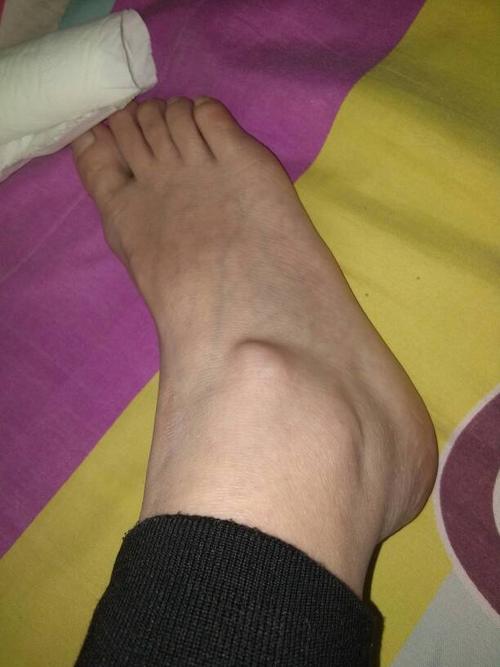 脚踝上一个疙瘩怎么回事儿