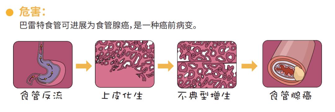 该进程大致为:食管反流→上皮化生→不典型增生→食管 barrett(巴雷特