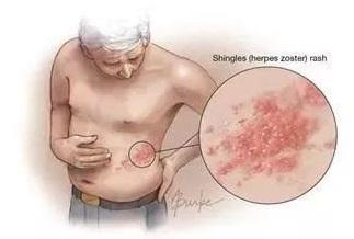 超过99%的50岁及以上成人曾感染过水痘-带状疱疹病毒