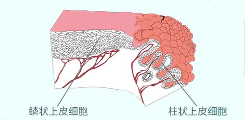 图片来源网络:百度健康 宫颈部位的柱状上皮细胞和鳞状上皮细胞处在一