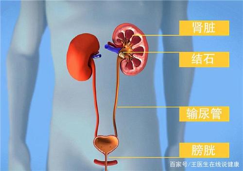体检检查出肾结石,别慌:三个办法,或能让肾结石离开