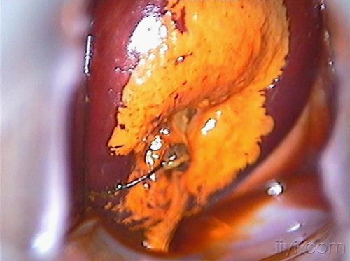 临床常见宫颈糜烂图片