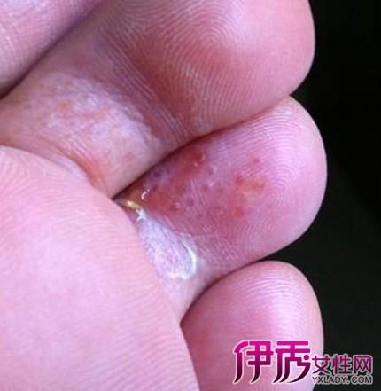 脚癣欲称"脚气",是一种浅部霉菌感染的皮肤病,它可分为干性和湿性两种