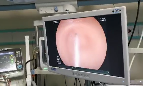 遵医附院重症医学二科成功开展电子胃镜引导下鼻空肠管置管术
